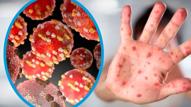 Detectaron el primer caso sospechoso de viruela del mono en la Argentina