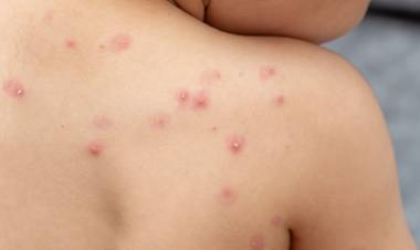 Aprueban una vacuna contra la viruela del mono