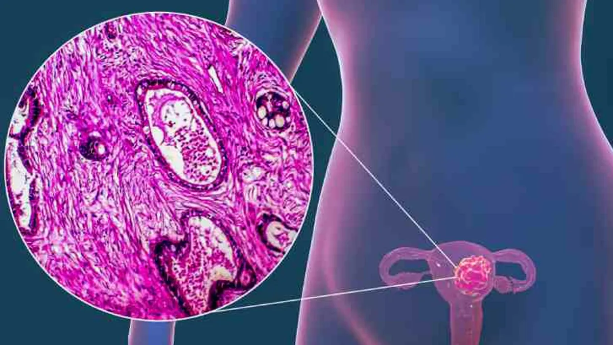 Presentan tratamiento para pacientes con cáncer de endometrio avanzado