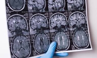 Argentinos lideran ensayo clínico de tratamiento contra un tipo de cáncer de cerebro