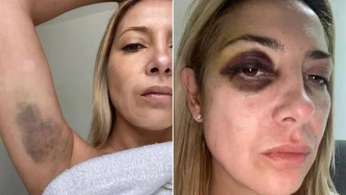 Denuncia contra Alberto Fernández: se filtraron fotos de Fabiola Yáñez golpeada