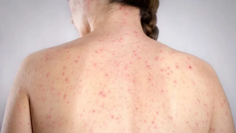 Salud informó un "posible caso" de sarampión en CABA y emitió alerta epidemiológico